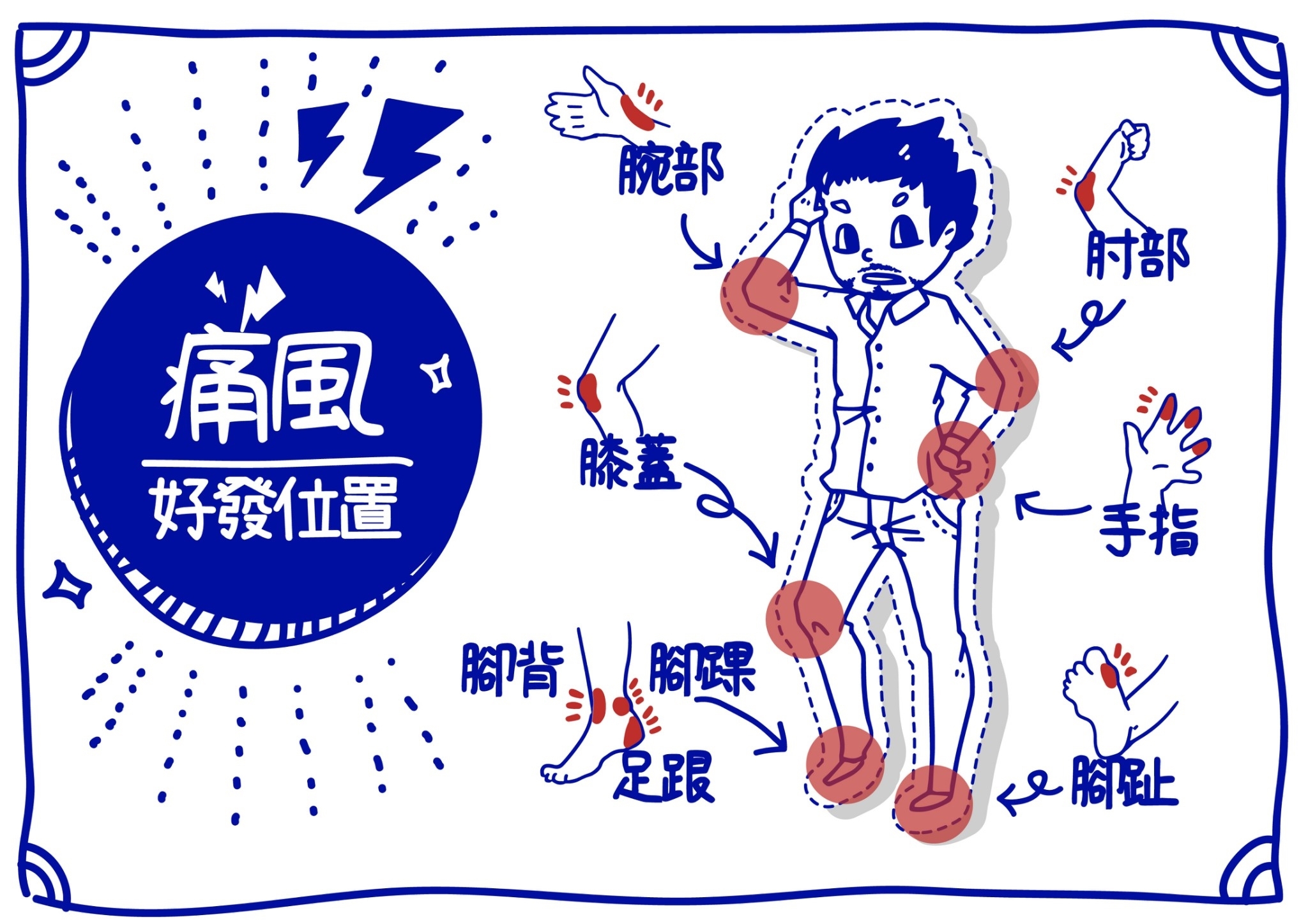 指出痛風部位的痛風照片