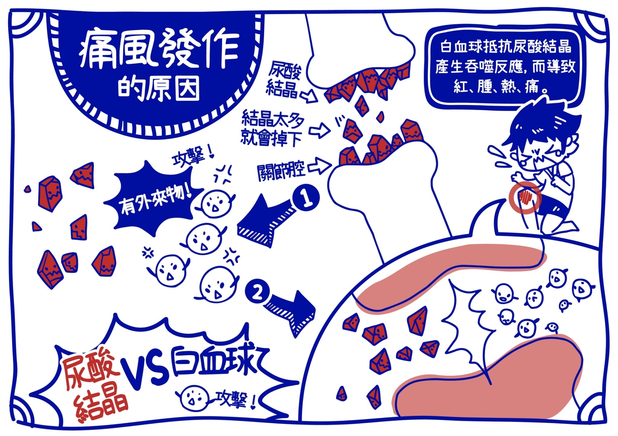 痛風發作原因