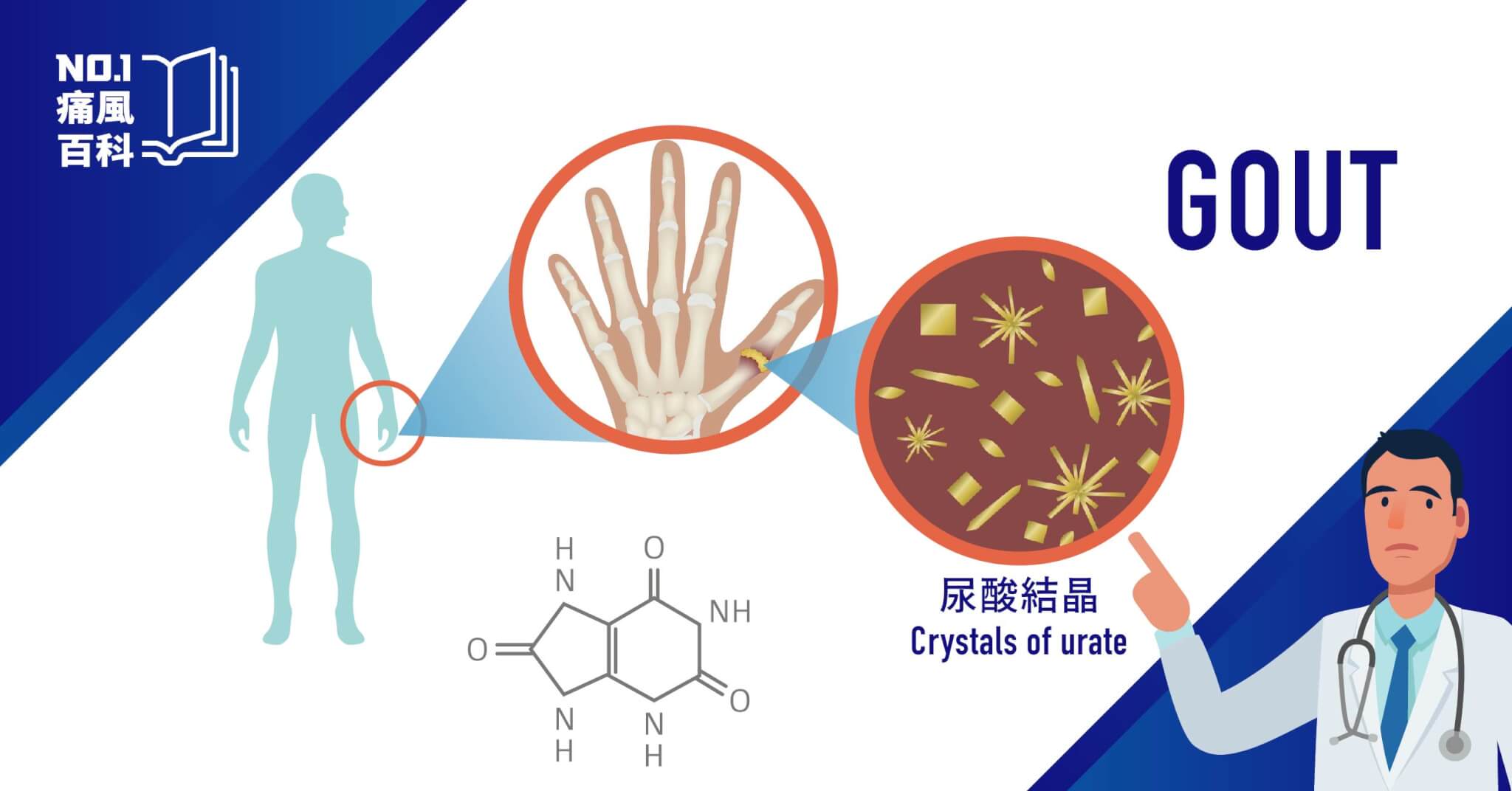 高尿酸血症症狀之一：痛風